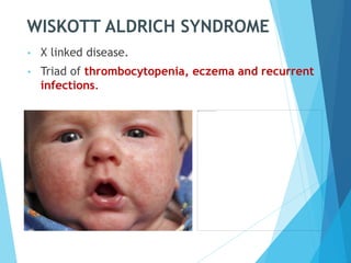 WISKOTT ALDRICH SYNDROME
• X linked disease.
• Triad of thrombocytopenia, eczema and recurrent
infections.
 