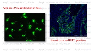 Anti-ds DNA antibodies in SLE
Breast cancer-HER2 positive
 