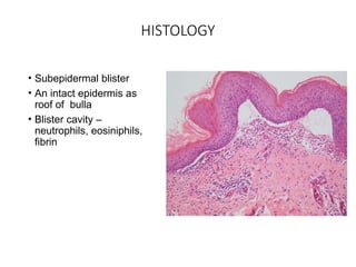 Comprehensive Overview of Autoimmune Bullous Disorders: Bullous ...