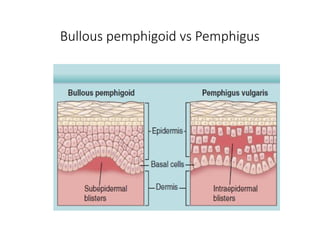 Bullous Process Comprehensive Overview of Autoimmune Bullous Disorders: Bullous ...