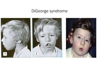 DiGeorge syndrome
 