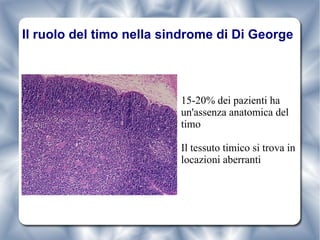 Il ruolo del timo nella sindrome di Di George 15-20% dei pazienti ha un'assenza anatomica del timo Il tessuto timico si trova in locazioni aberranti 