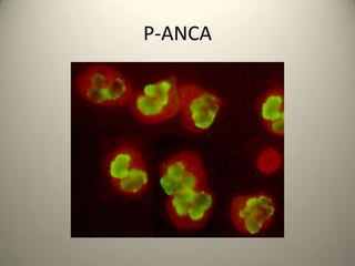 P Anca Pattern Immunofluorescence | PPTX