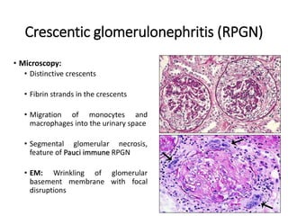 Crescentic Rpgn Immunofluorescence and its role in histopathology | PPTX