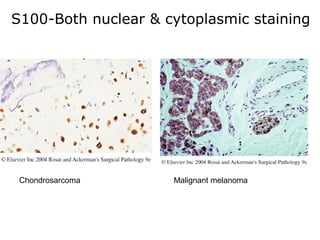 S100-Both nuclear & cytoplasmic staining
Chondrosarcoma Malignant melanoma
 