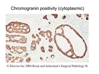 Chromogranin positivity (cytoplasmic)
 