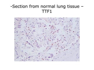 -Section from normal lung tissue –
TTF1
 