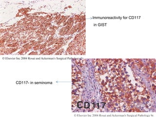 Immunoreactivity for CD117
in GIST
CD117- in seminoma
 