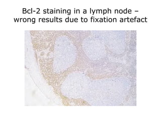 Bcl-2 staining in a lymph node –
wrong results due to fixation artefact
 