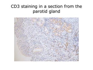 CD3 staining in a section from the
parotid gland
 