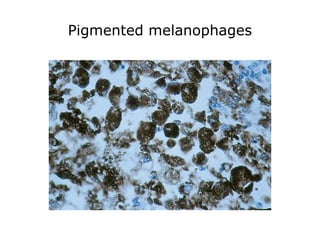 Pigmented melanophages
 
