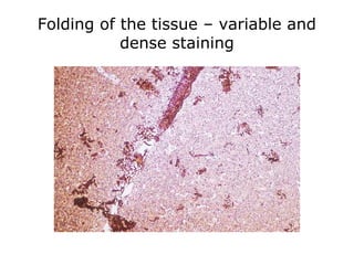 Folding of the tissue – variable and
dense staining
 