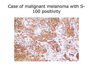 Case of malignant melanoma with S-
100 positivity
 