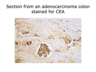 Section from an adenocarcinoma colon
stained for CEA
 
