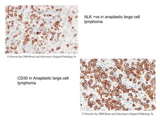 ALK +ve in anaplastic large cell
lymphoma
CD30 in Anaplastic large cell
lymphoma
 