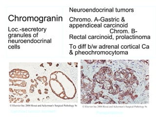 Chromogranin
Loc.-secretory
granules of
neuroendocrinal
cells
Neuroendocrinal tumors
Chromo. A-Gastric &
appendiceal carcinoid
Chrom. B-
Rectal carcinoid, prolactinoma
To diff b/w adrenal cortical Ca
& pheochromocytoma
Carcinoid tumour stomach Paraganglioma
 