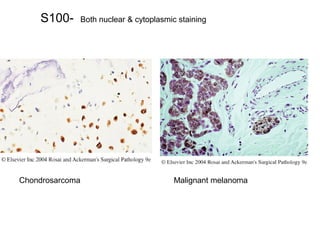 S100- Both nuclear & cytoplasmic staining
Chondrosarcoma Malignant melanoma
 