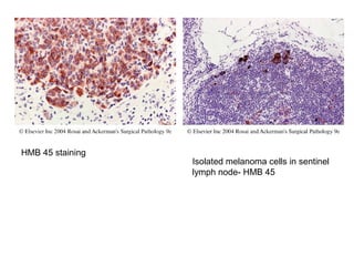 HMB 45 staining
Isolated melanoma cells in sentinel
lymph node- HMB 45
 