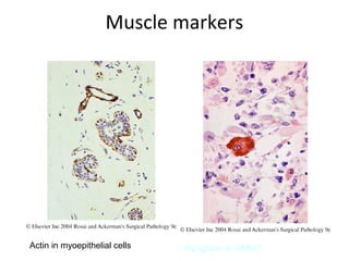 Muscle markers
Actin in myoepithelial cells Myoglobin in MMMT
 