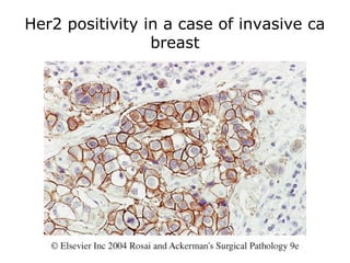Her2 positivity in a case of invasive ca
breast
 