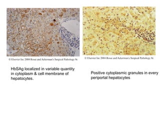 HbSAg localized in variable quantity
in cytoplasm & cell membrane of
hepatocytes.
Positive cytoplasmic granules in every
periportal hepatocytes.
 