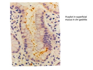 H-pylori in superficial
mucus in chr gastritis
 