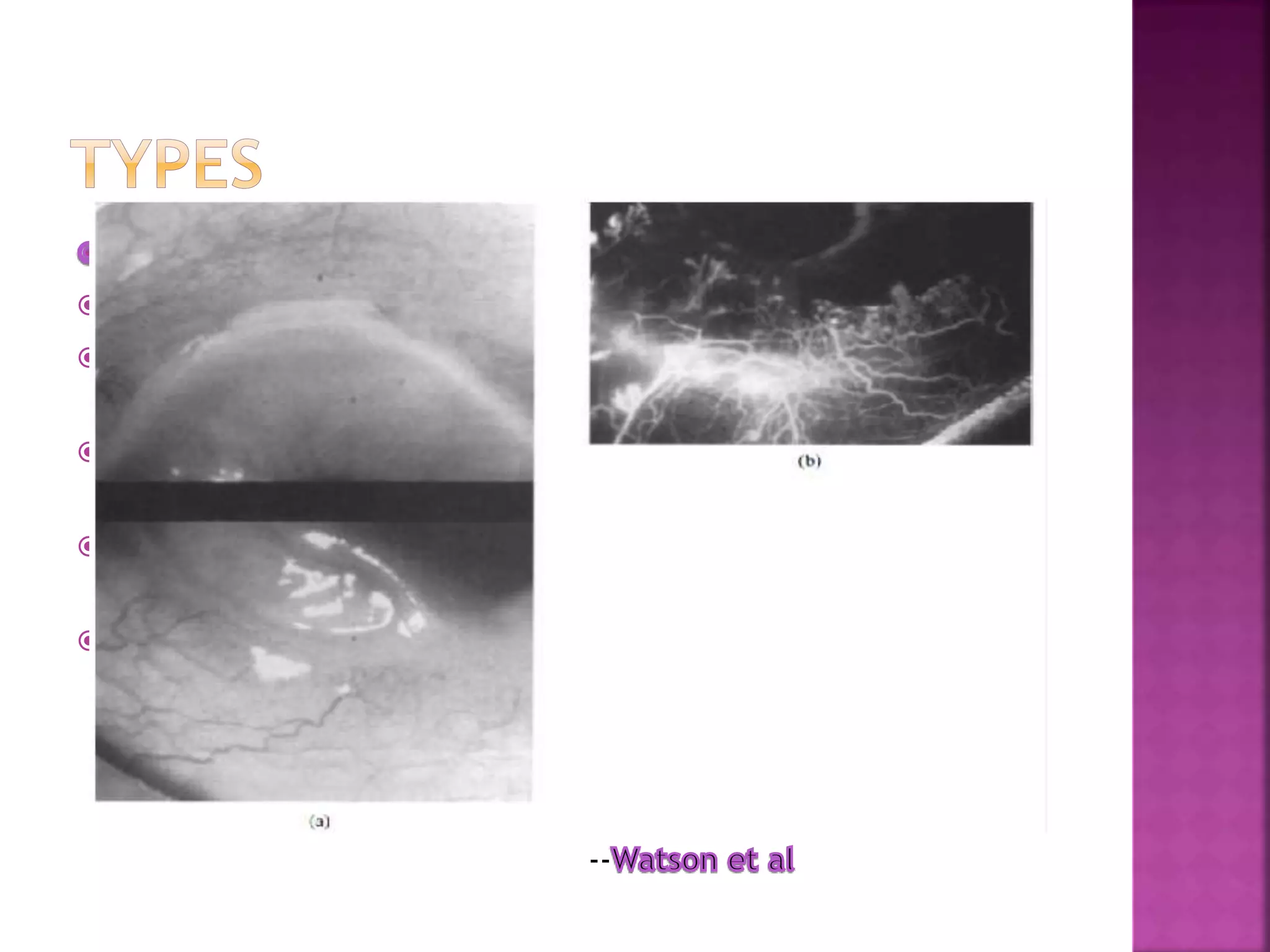 : excesive painful
 Seen in elderly
 Affected eyes are red and congested but
inflammation doesnot extend 3mm beyond limbus.
 Vascularization of ulcer bed is seen alomg with
leakage at tips of new vessels
 Ulceration extends around the globe and leaves thick
opaque central cornea
 Fluroscein angio: venular occlusion of local episcleral
and conjunctival blood vessels along with disruption
of limbal arcade and vascular leakage from deep
vessels at limbus and base of ulcer, vasoobliteration
of sup vascular arcades is characteristic
--
 