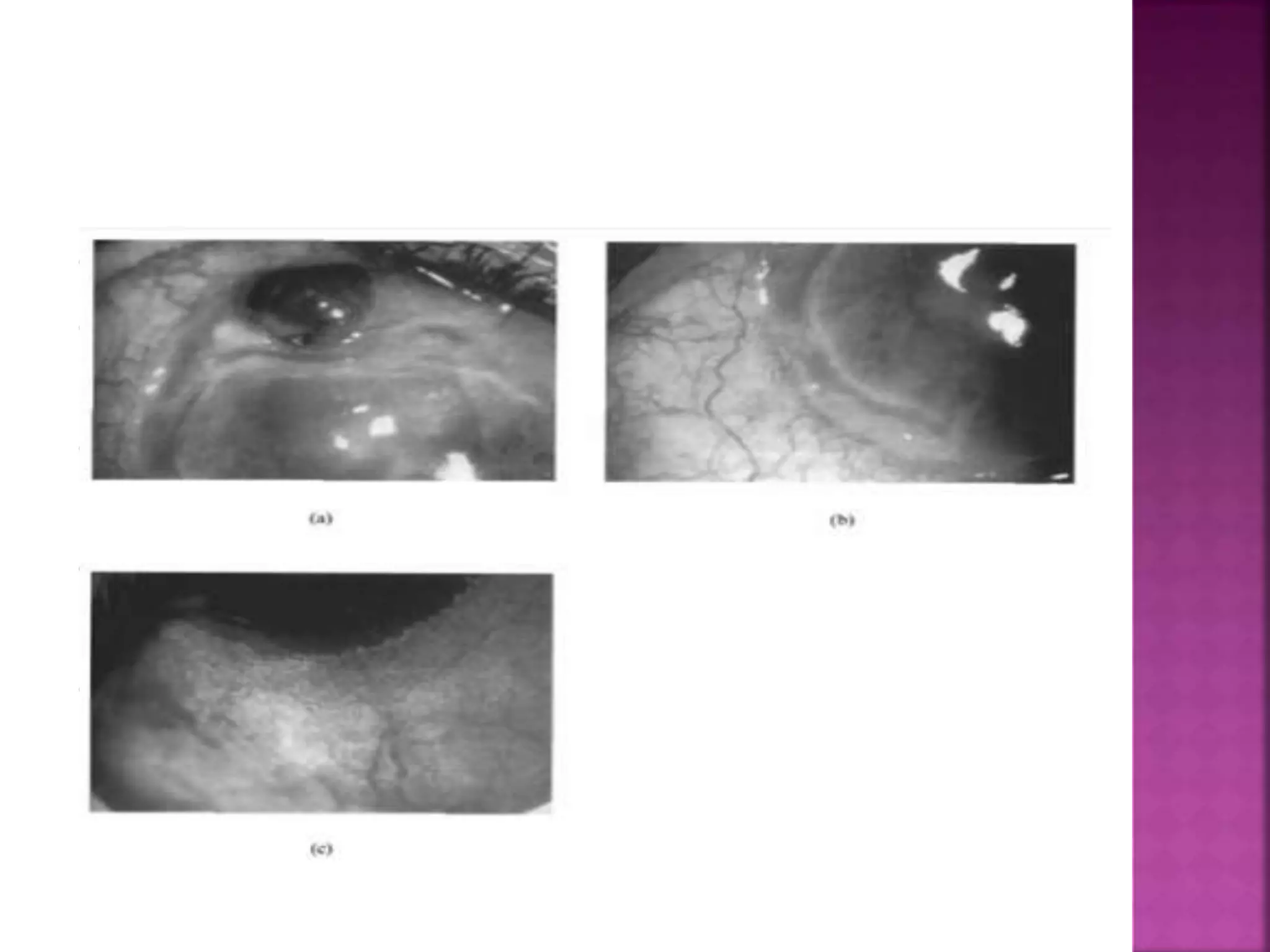  Type 3- indolent, affects mid age
 Corneal guttering in both eyes with little
inflammation.
 Disease more severe in one eye and patient
complain of discomfort.
 Most cases are progressive but some heal
spontaneously. Few may be quiscient.
 FA- vascular architecture is normal except
new vessel may extend upto base of ulcer.
 