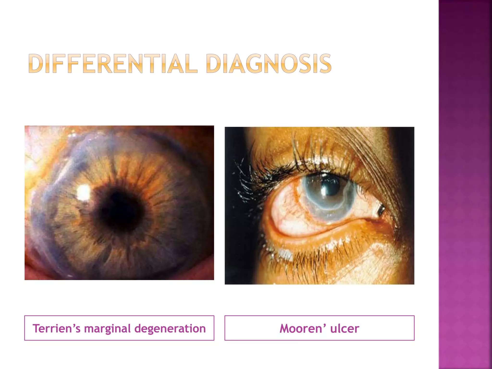 Terrien’s marginal degeneration Mooren’ ulcer
 