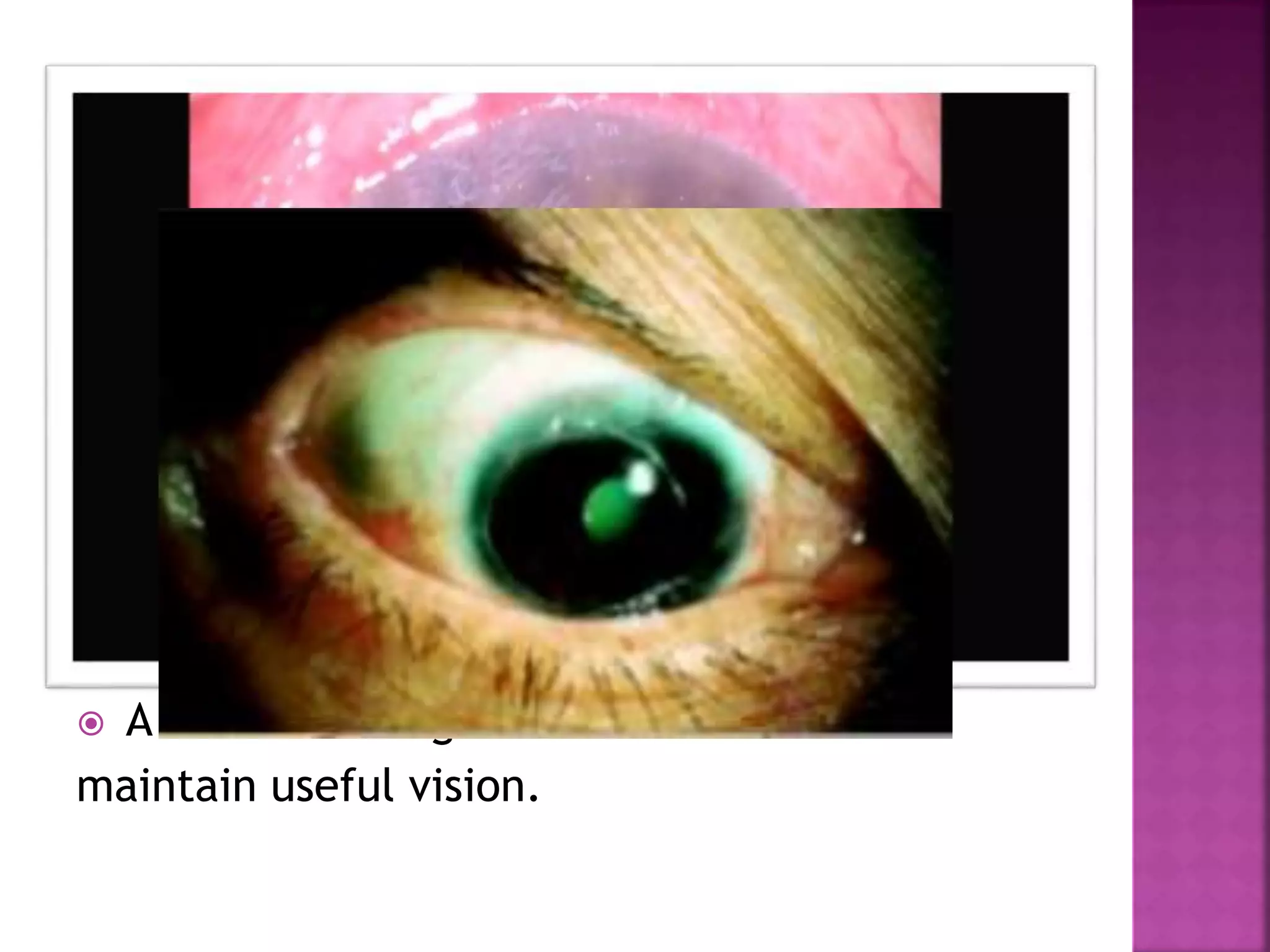 For an ulcer smaller than half circle of the
limbus and the central 7-8 mm of the cornea
uninvolved crescent shaped lamellar graft
can be used.
 For an ulcer larger than 2/3 of a circle of the
limbus where the central 7-8 mm of cornea is
intact, a doughnut shaped lamellar graft is
recommended.
 A full lamellar graft is used to
maintain useful vision.
 