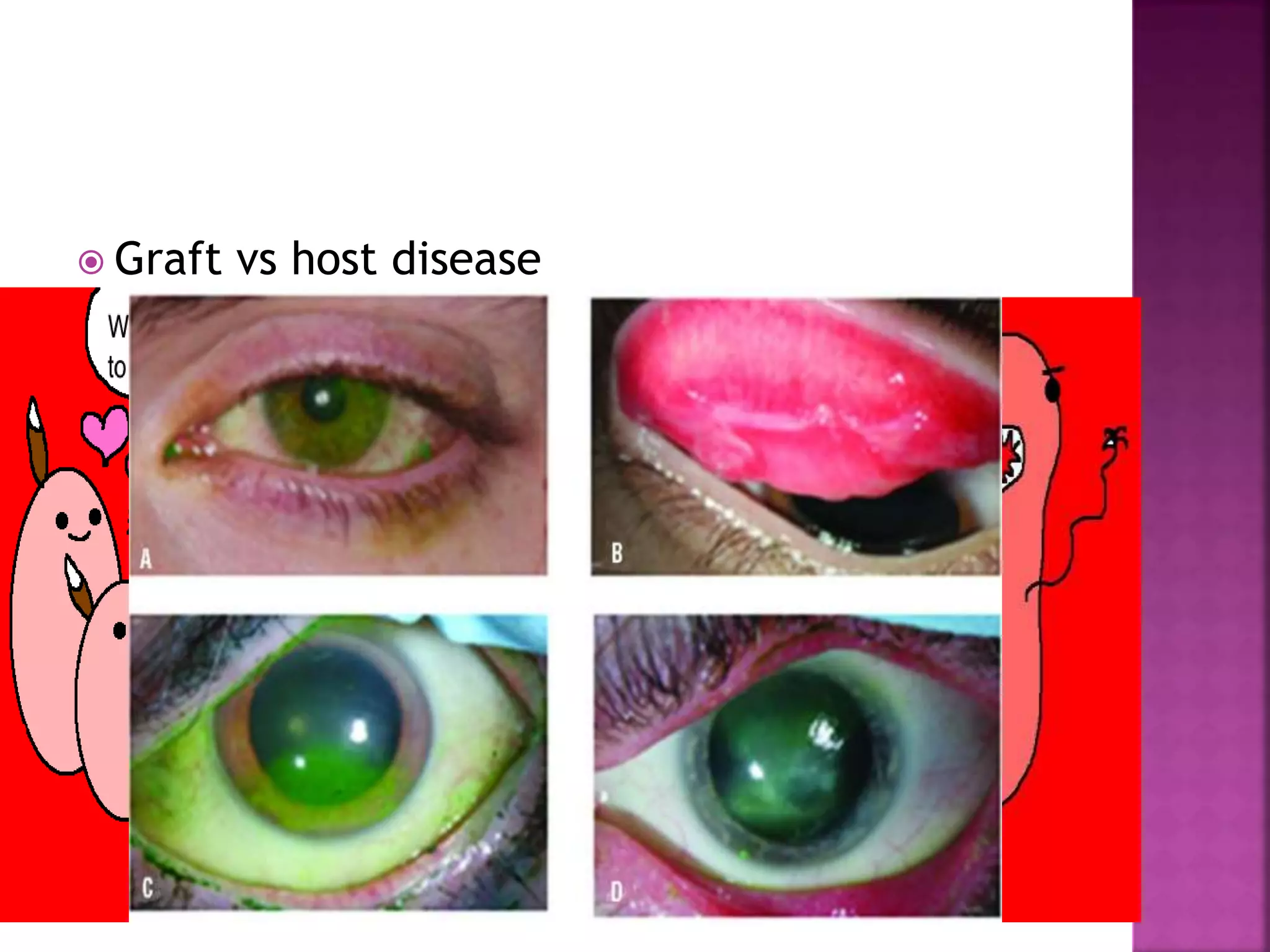  Graft vs host disease
 