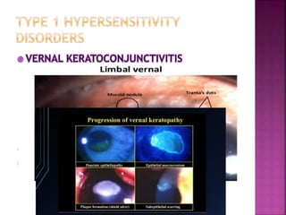  Clinical features:
 Pathogenesis:
 Treatment:
a) Control the symptoms
b) Limit the sight threatening complications
 
