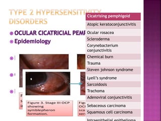Cicatrising pemphigoid
Atopic keratoconjunctivitis
Ocular rosacea
Scleroderma
Corynebacterium
conjunctivitis
Chemical burn
Trauma
Steven johnson syndrome
Lyell’s syndrome
Sarcoidosis
Trachoma
Adenoviral conjunctivitis
Sebaceous carcinoma
Squamous cell carcinoma
 