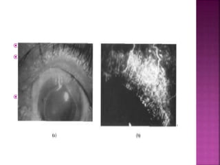 Type 2- bilateral, occurs in young
 Pain is less severe , pain in one eye and
congestion in other eventually progress to
develop grey patches within corneal stroma
and 2mm from edge of limbus.
 FA : shows vascular leakage and new vessel
formation that reaches base of ulcer, also
shows change in architecture of episcleral
vessels and blockage in addition to break up
of limbal arcade
 
