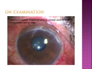 There is a cresent shaped peripheral corneal ulcer with an
undermined central edge
 
