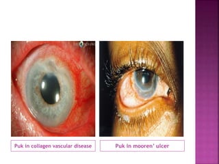Puk in collagen vascular disease Puk in mooren’ ulcer
 