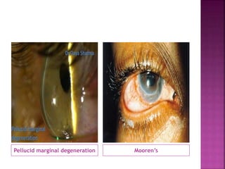 Pellucid marginal degeneration Mooren’s
 