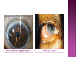 Senile furrow degeneration Mooren’ ulcer
 