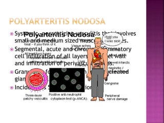  Systemic, necrotrizing vasculitis that involves
small and medium sized muscular arteries.
 Segmental, acute and chronic inflammatory
cell infiltration of all layers of vessel wall
and infiltration of perivascular areas.
 Granuloma formation wuth multinucleated
giant cells.
 Incidence is 5-220 per million
 