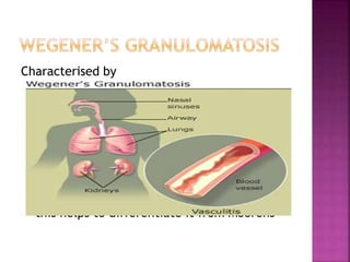 Characterised by
Peripheral ulcerative keratitis is the initial
ocular manifestation (50-60%)
- Sometimes maybe preceded by conjunctivitis
or episcleritis
- Crescentic peripheral corneal ulcer that
resembles Mooren’s ulcer
- Scleral involvement is invariably present
- this helps to differentiate it from Moorens
 