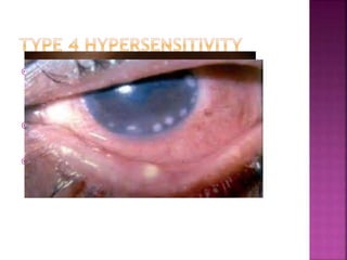  PHLYCTENULOSIS
 STAPHYLOCOCCAL HYPERSENSITIVITY
 CONTACT LENS-ASSOCIATED INFILTRATES
 