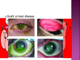  Graft vs host disease
 