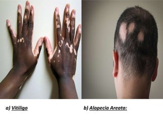 a) Vitiligo b) Alopecia Areata:
 