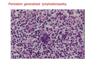 Persistent  generalized  lymphadenopathy 