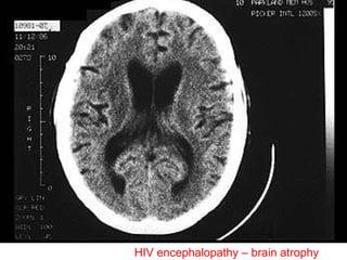 HIV encephalopathy – brain atrophy 