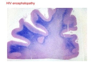 HIV encephalopathy 