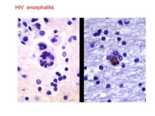 HIV  encephalitis 