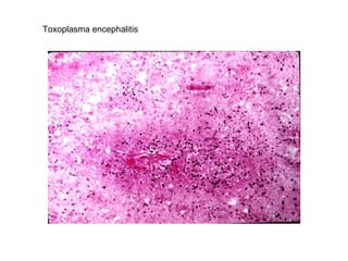 Toxoplasma encephalitis 