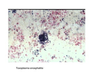 Toxoplasma encephalitis 