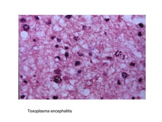 Toxoplasma encephalitis 